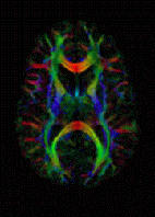 Diffusion-weighted magnetic resonance imaging